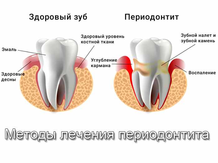 методы лечения периодонтита